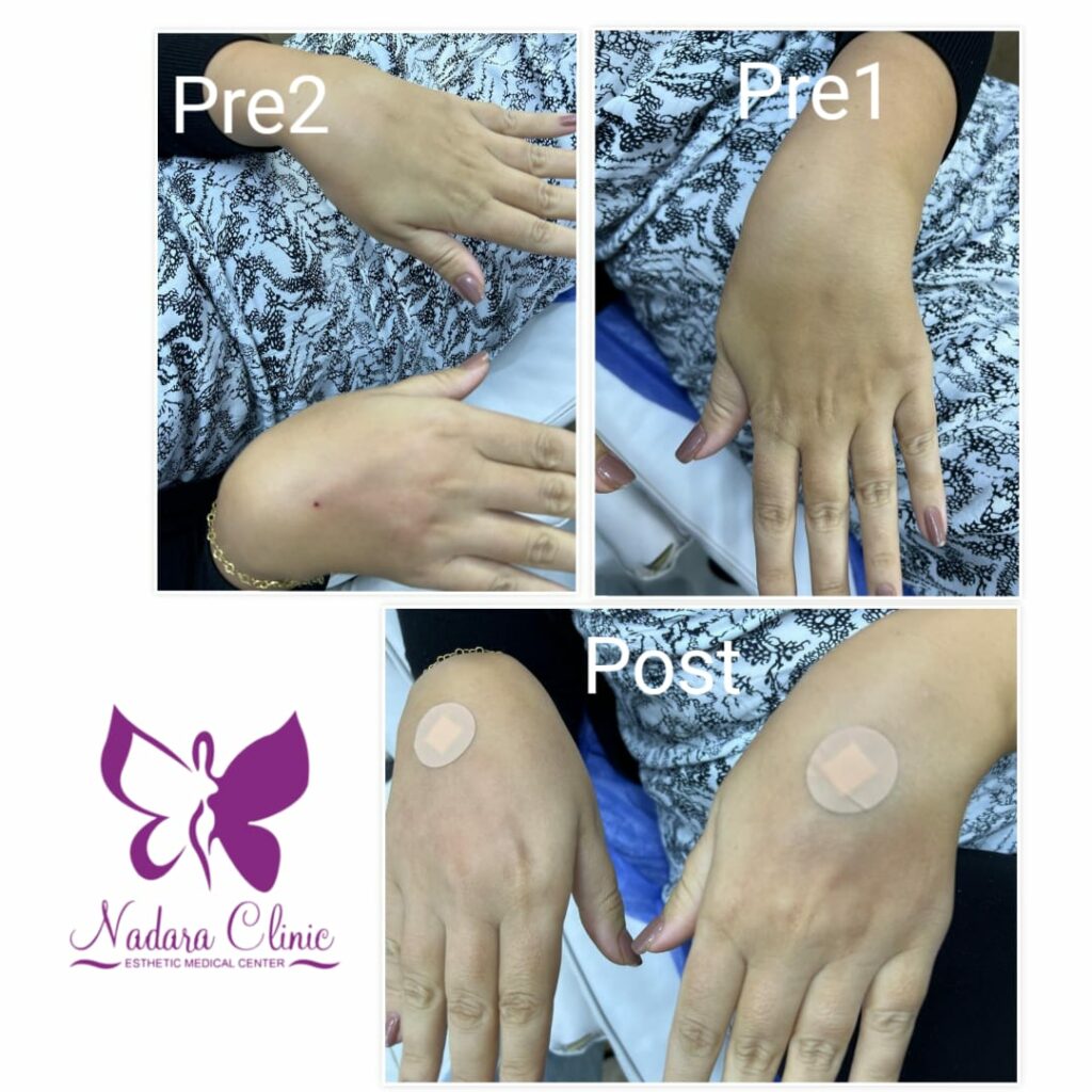 علاج تجاعيد اليدين